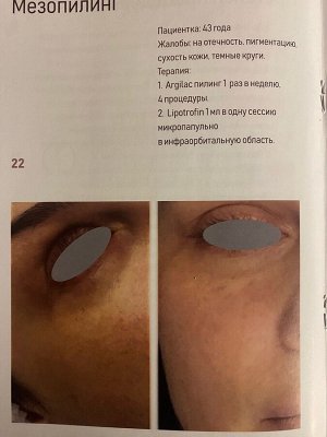 SIMILDIET ARGILAK MASK (Аргининовый пилинг)