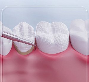 Ультразвуковой скалер для удаления зубного камня Xiaomi T-Flash J3