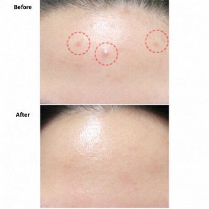 Крем-гель точечный восстанавливающий J'sDerma Acnetrix Blemish Red Spot Gel