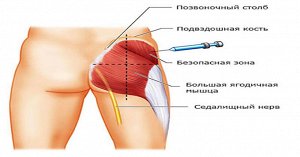 МосМедика Шприц-пистолет. Устройство для инъекций медицинское многоразовое