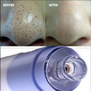 Аппарат для вакуумной очистки пор лица Spot Cleaner