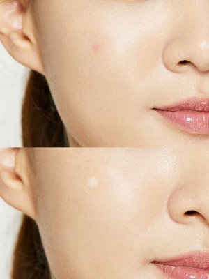 Пластыри от прыщей Cosrx Acne Pimple Master Patch