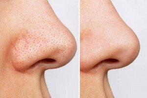 Кислотный крем против черных точек и забитых пор Manyo Blackhead &amp; Pore Cream 30мл