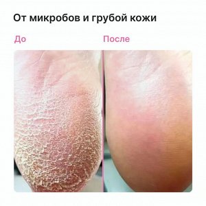 Пенка с антигрибковым эффектом против трещин и натоптышей EpilProfi 150 мл