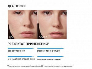 ICON SKIN RE:PROGRAM ACNE FREE Пилинг для проблемной кожи 18 % Anti-Acne, 30 мл.