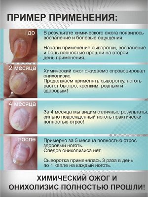 Сыворотка для восстановления и укепления ногтей СтопОнихолизис с маслом монарды 30 мл. Giorgio Capachini