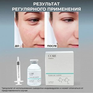 Сыворотка для лица, Matrigen, с гиалуроновой килотой, увлажняющая, для мезотерапии лица руками и аппаратом, 30 мл