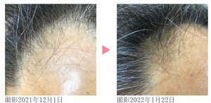 REY Breathing Hair Grow Lotion - лосьон для поддержки роста волос и против выпадения