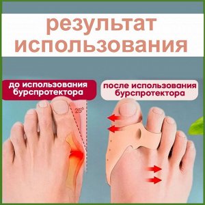 Бурсопротекторы большого пальца стопы с межпальцевой перегородкой (пара)