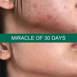 Some By Mi Кислотный крем для проблемной кожи AHA-BHA-PHA 30 Days Miracle Cream