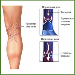 Мазь от варикоза вен на ногах