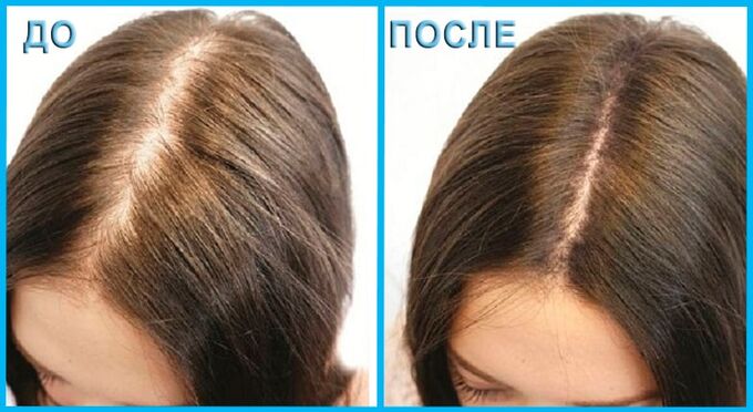 Лосьон для роста волос Миноксидил (Minoxidil Equate) 2% - для женщин 3*60  мл |. Косметические наборы для волос